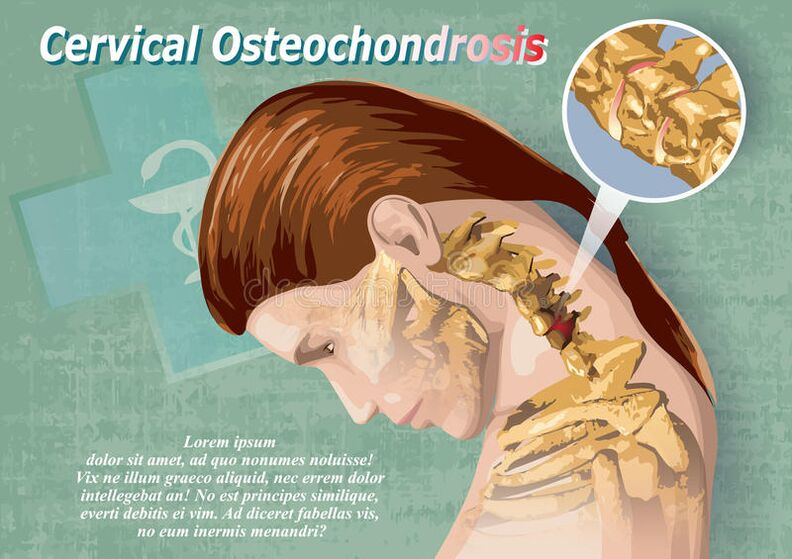 Servikal osteokondroz, kıkırdak dokusunun bir hastalığıdır
